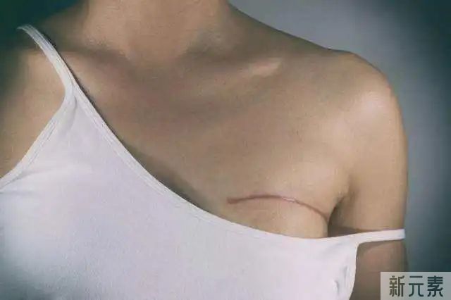 乳腺癌手术后如何预防疤痕?这篇文章跟您讲清楚! 图片-3