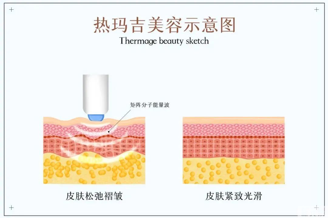 除了拉皮除皱，还有哪些方式能对抗面部松垂凹陷? 图片-6
