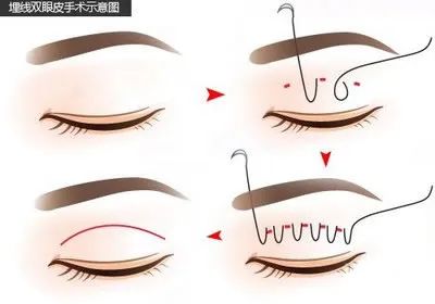 双眼皮手术价为什么差距这么大? 图片-5