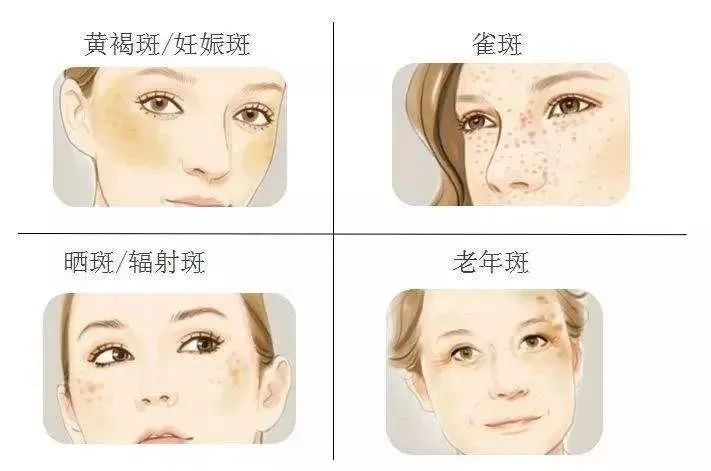 当心!脸上能看到的斑，可能只是冰山一角...... 图片-3