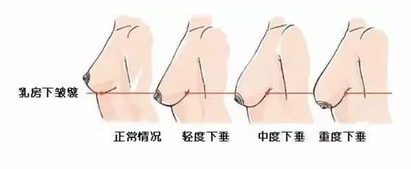 爆哭!原来胸部的形状还分这么多种? 图片-7