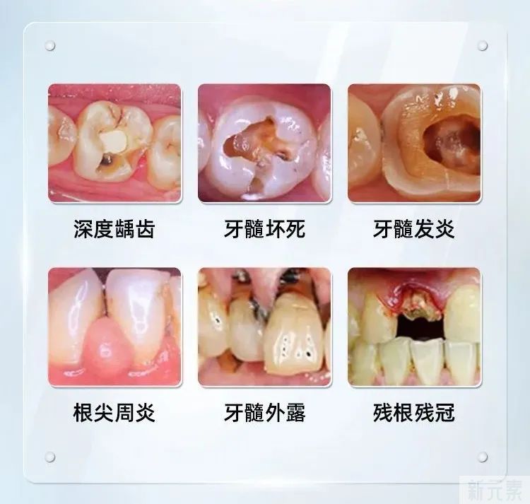 根管治疗后做牙冠，是画蛇添足还是锦上添花呢? 图片-5