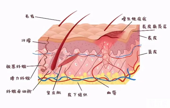 如果是疤痕体质，可以做双眼皮吗? 图片-3