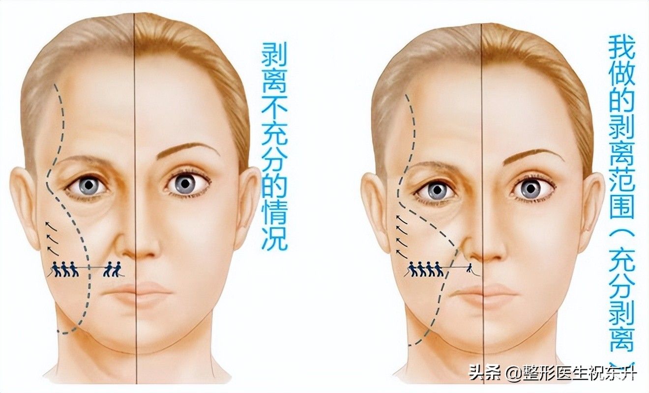 做拉皮3个月，好像变化不大，问题到底出在哪? 图片-1