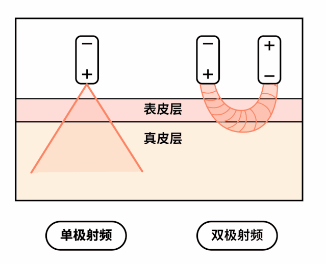 热玛吉,了解清楚再做也不迟 图片-8