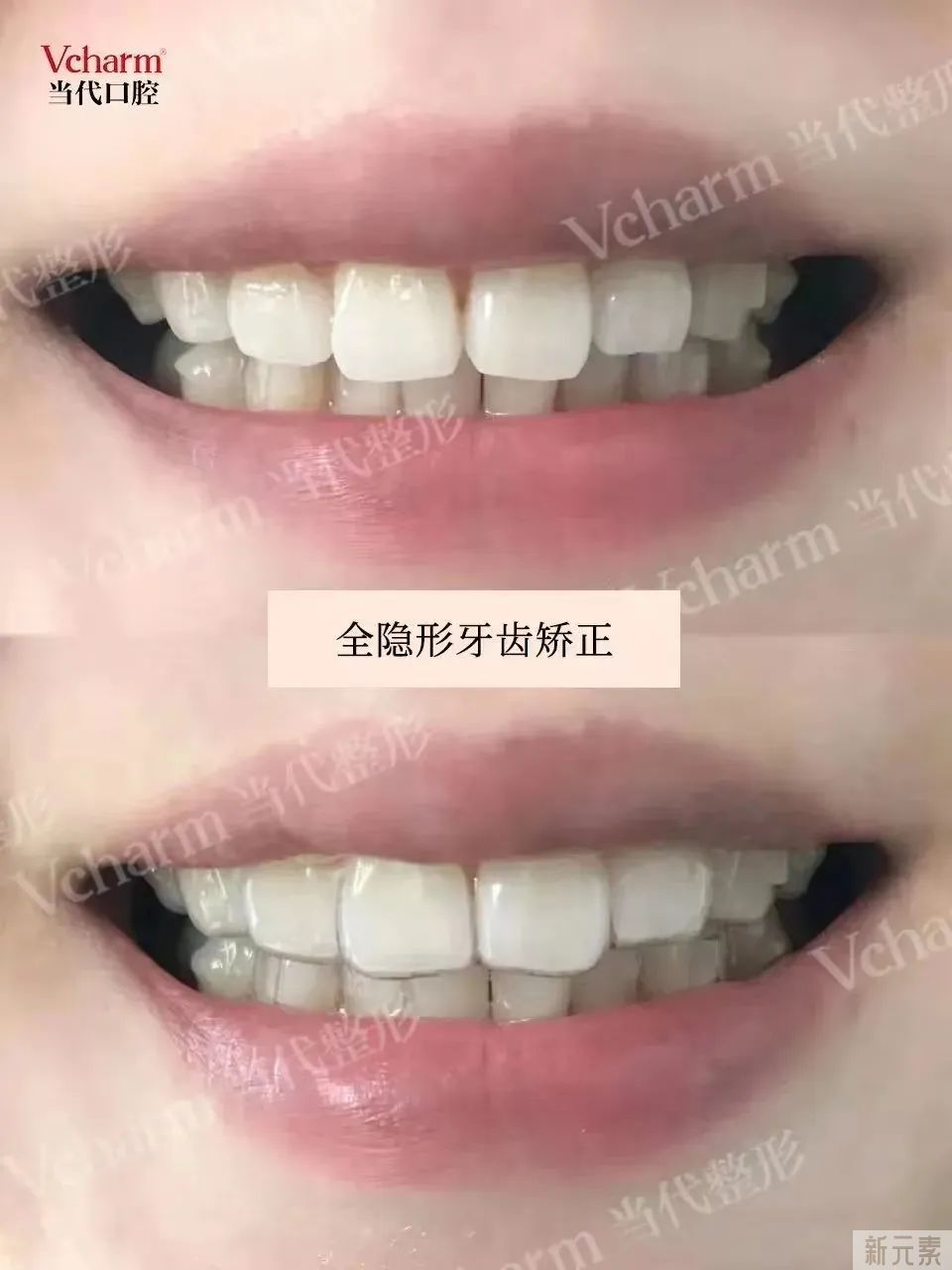 牙齿出现这几种状况，一定要去做矫正! 图片-13