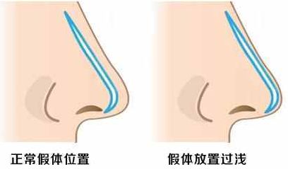隆鼻老了以后，会变成什么样? 图片-3