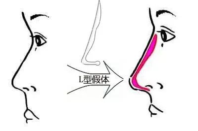隆鼻老了以后，会变成什么样? 图片-2