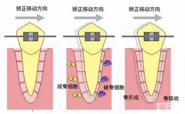 速看!牙齿矫正为什么会失败? 图片-8
