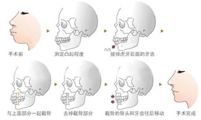 速看!牙齿矫正为什么会失败? 图片-6