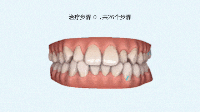 成年后去做牙齿矫正到底值不值?医生这么分析 图片-10