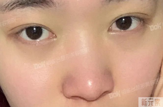科普 | 美鼻不仅仅是垫高鼻梁那么简单的事，这两条“线”很重要! 图片-8