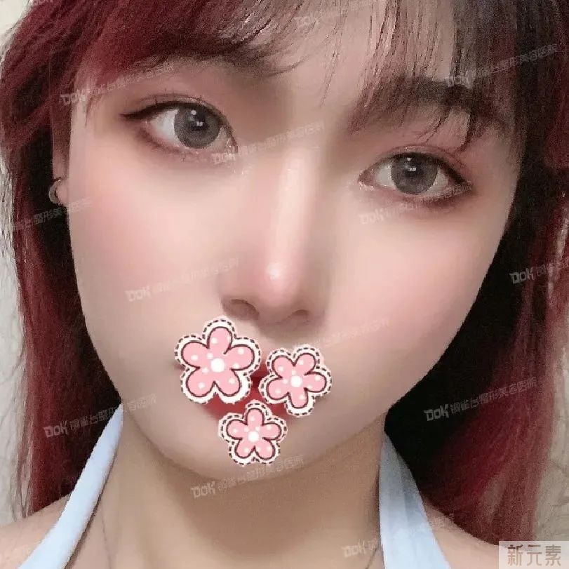 科普 | 美鼻不仅仅是垫高鼻梁那么简单的事，这两条“线”很重要! 图片-15