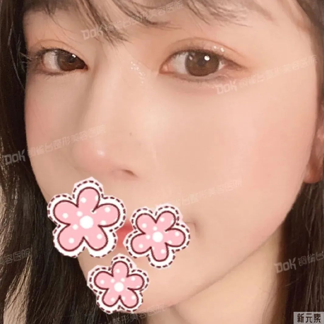 科普 | 美鼻不仅仅是垫高鼻梁那么简单的事，这两条“线”很重要! 图片-27