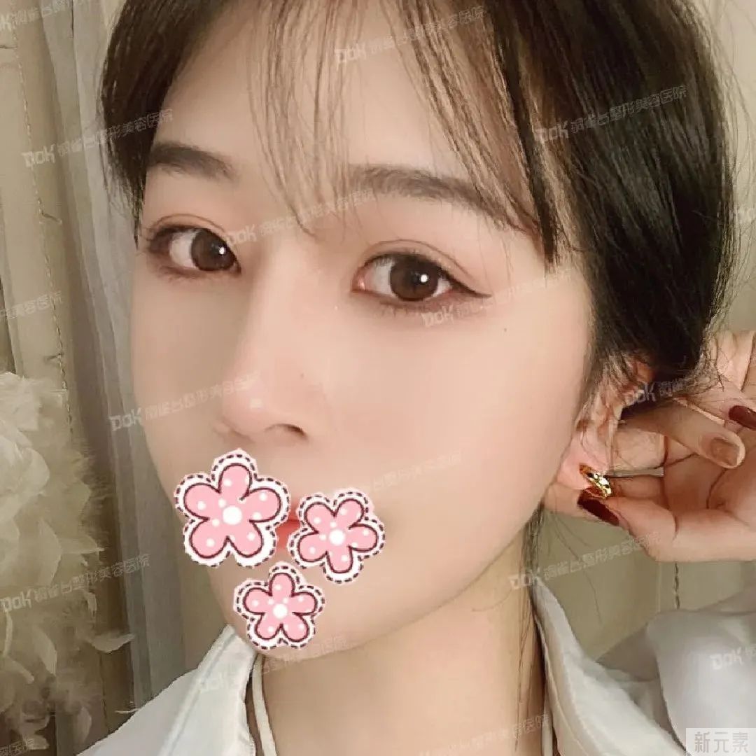 科普 | 美鼻不仅仅是垫高鼻梁那么简单的事，这两条“线”很重要! 图片-28