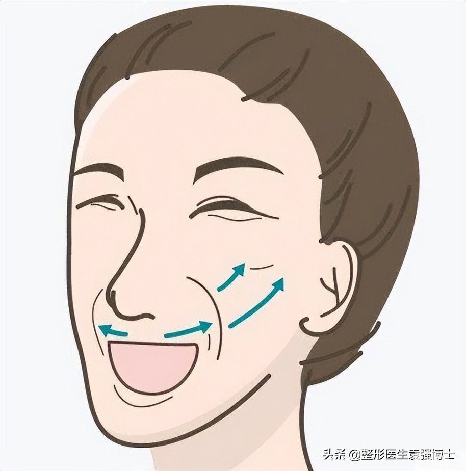 仅靠拉皮就能完全去除“法令纹”?别被骗了，听医生说真相 图片-3