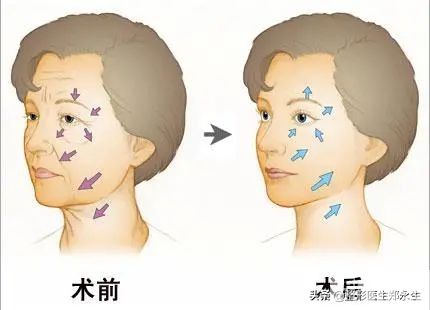 眶周老化的表现和治疗策略 图片-8
