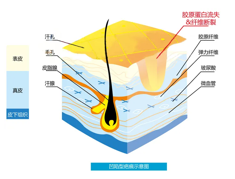 凹陷疤痕是怎么形成的?还能修复吗? 图片-3