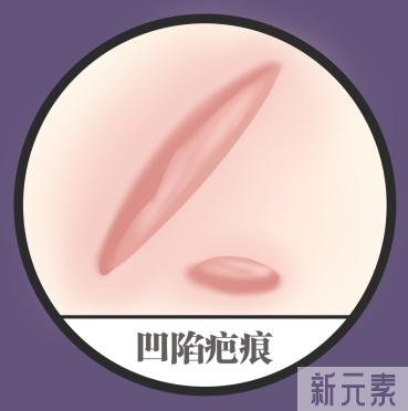 凹陷疤痕是怎么形成的?还能修复吗? 图片-1