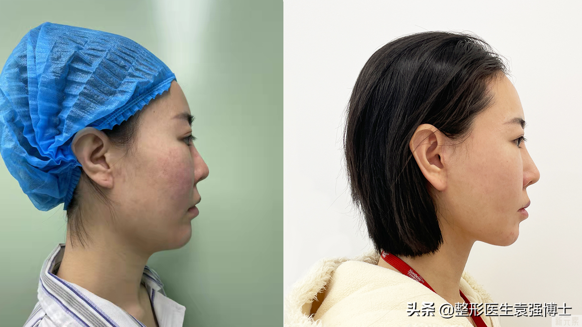 医生说:40后抗衰医美项目这5个还不错，越做越年轻 图片-4