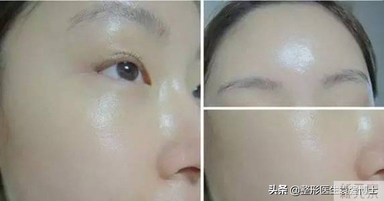 医生说:40后抗衰医美项目这5个还不错，越做越年轻 图片-3