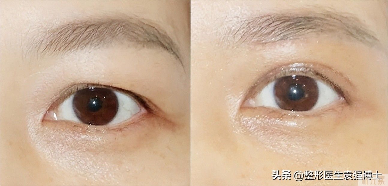 医生说:40后抗衰医美项目这5个还不错，越做越年轻 图片-5