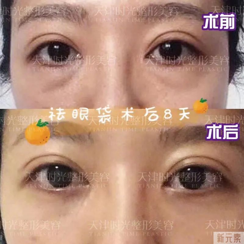 真假眼袋改善方法不同，这篇教您辨别是否需要手术 图片-2