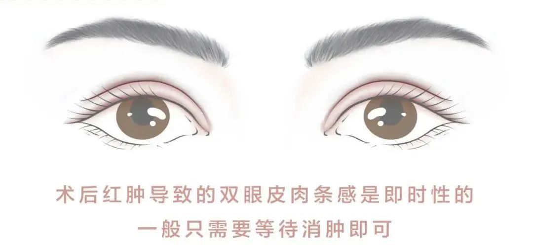 为什么有的人做了双眼皮，更显老? 图片-6