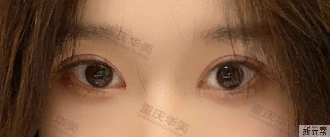 为什么有的人做了双眼皮，更显老? 图片-12