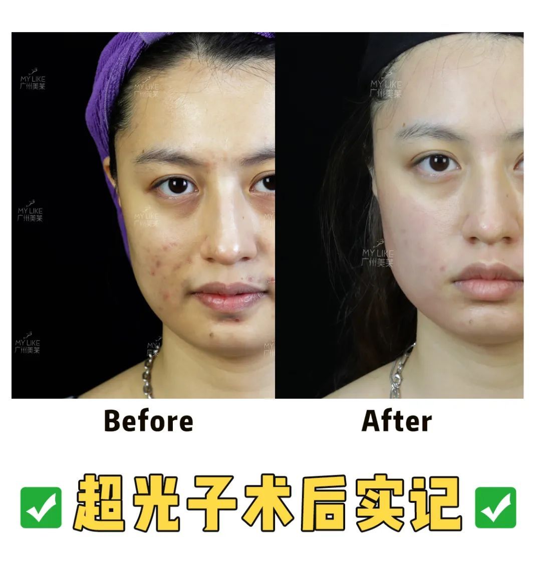 戒油戒辣15年依旧满脸痘....而闺蜜只用了1招 图片-7