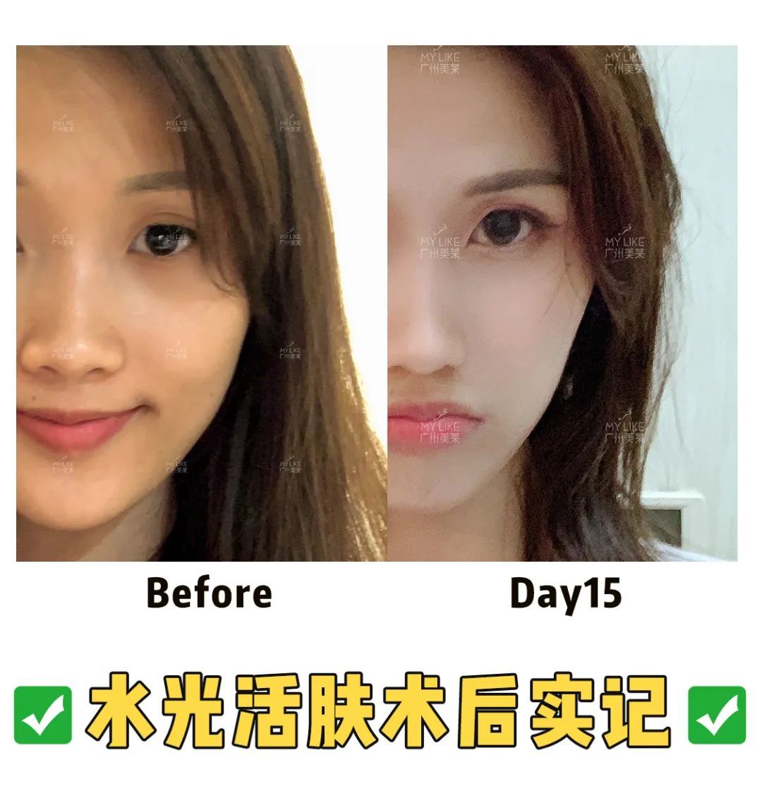 戒油戒辣15年依旧满脸痘....而闺蜜只用了1招 图片-10
