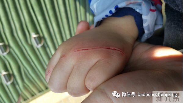 三步!处理孩子意外伤口 图片-2