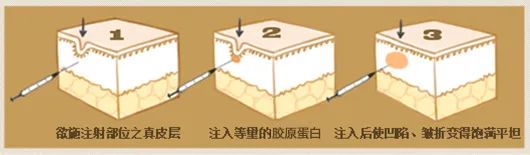 哪种除皱方式更适合你? 图片-6