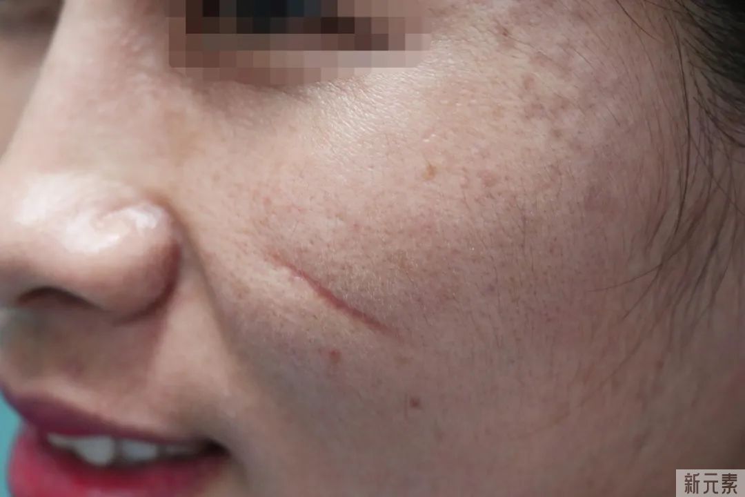凹陷疤痕有哪几种类型?自己的疤痕又属于哪种? 图片-2
