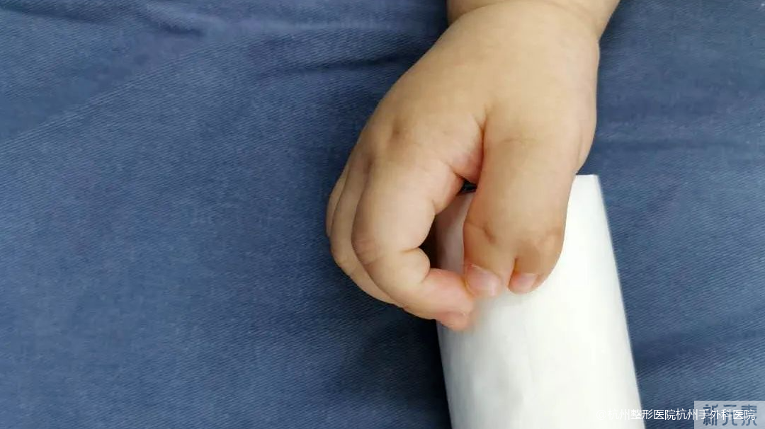 宝宝天生多了手指?别用“土偏方”!手术切除，还宝宝一个正常手 图片-3