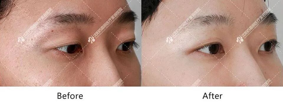 脸这里有了凹陷，不仅显老，还显脸大，怎么补救? 图片-5