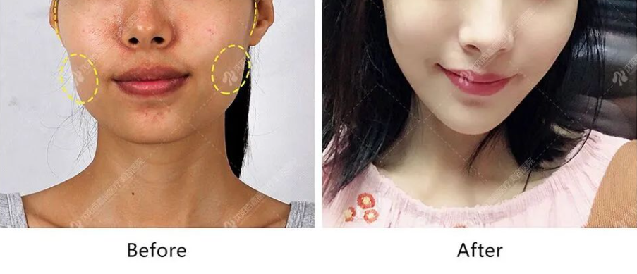脸这里有了凹陷，不仅显老，还显脸大，怎么补救? 图片-9