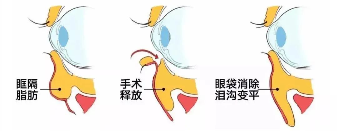 年轻人不长眼袋?这些祛眼袋的误区，你信了几个? 图片-12