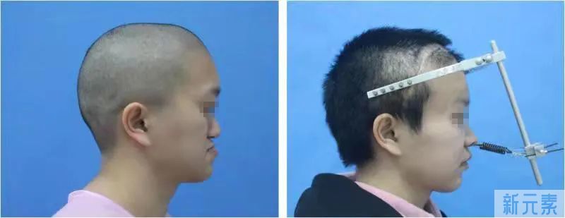【颅骨眼眶先天畸形】早诊早治有利于儿童身心健康成长 图片-4