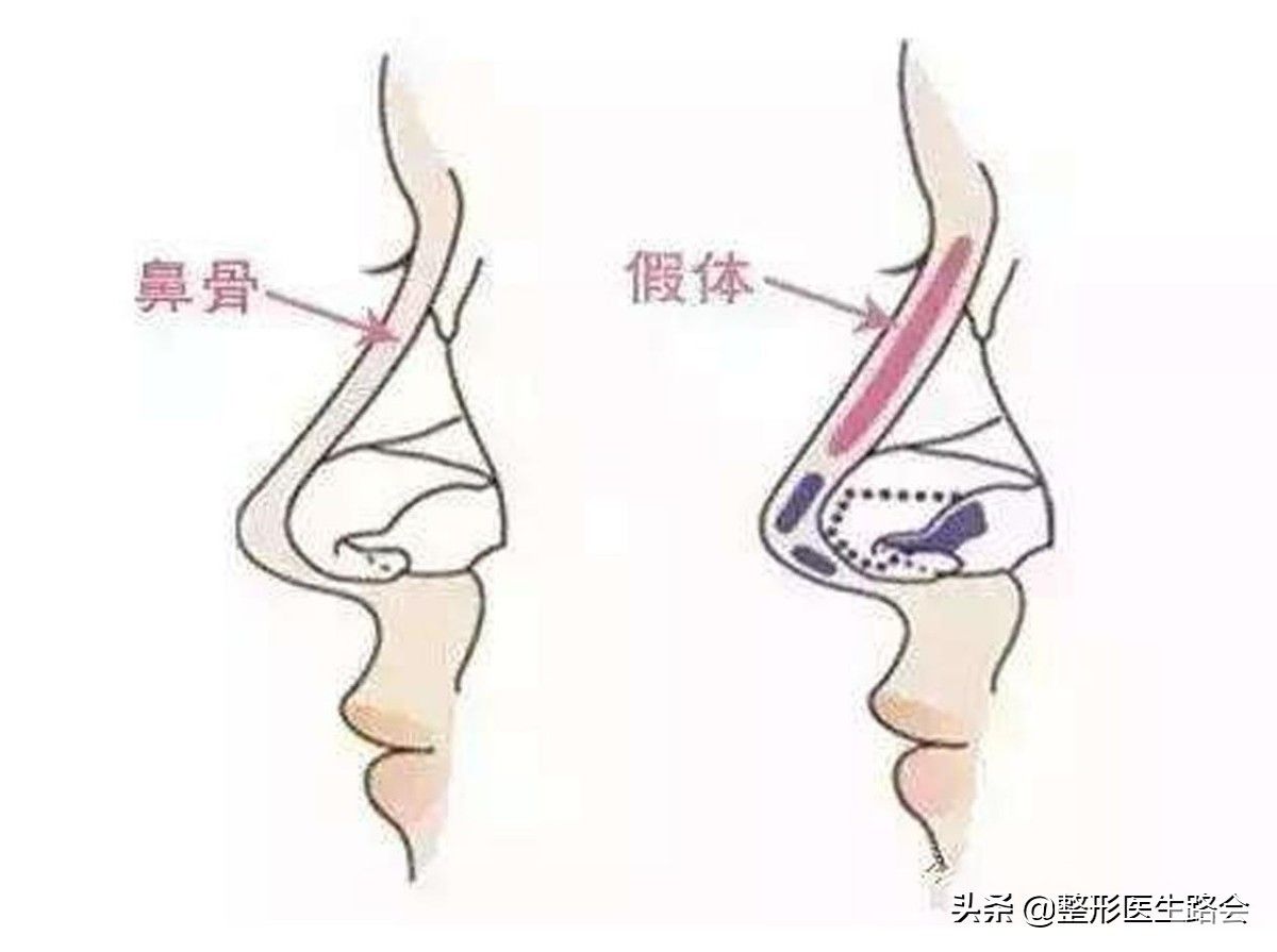 隆鼻后嗅觉失灵!是暂时的?还是永久的?听听三甲医生怎么说? 图片-4