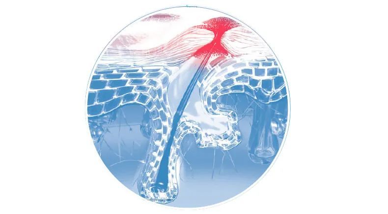 油皮、痘肌、“月球脸”，我该拿什么拯救? 图片-6