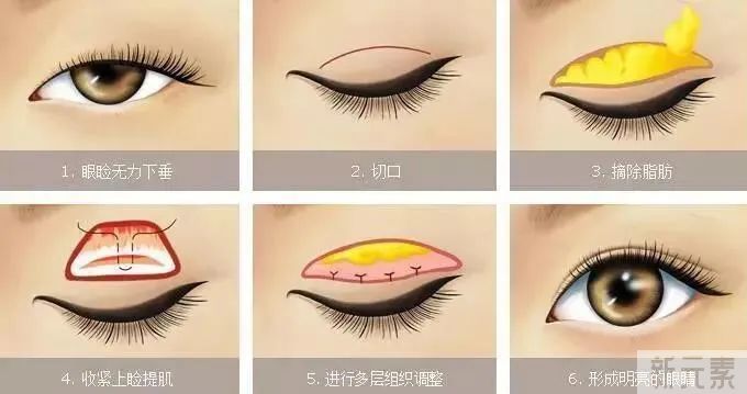 双眼皮什么年龄做合适?不同年龄段适合什么术式? 图片-12