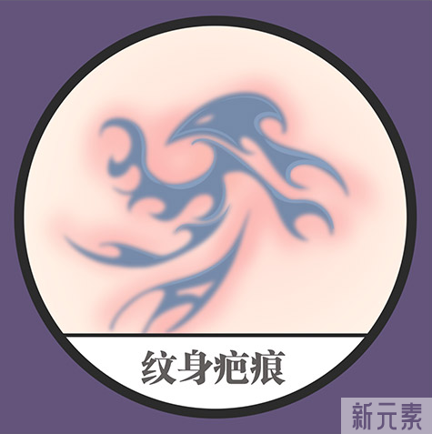 洗纹身后留疤了怎么办?应如何科学防治? 图片-7