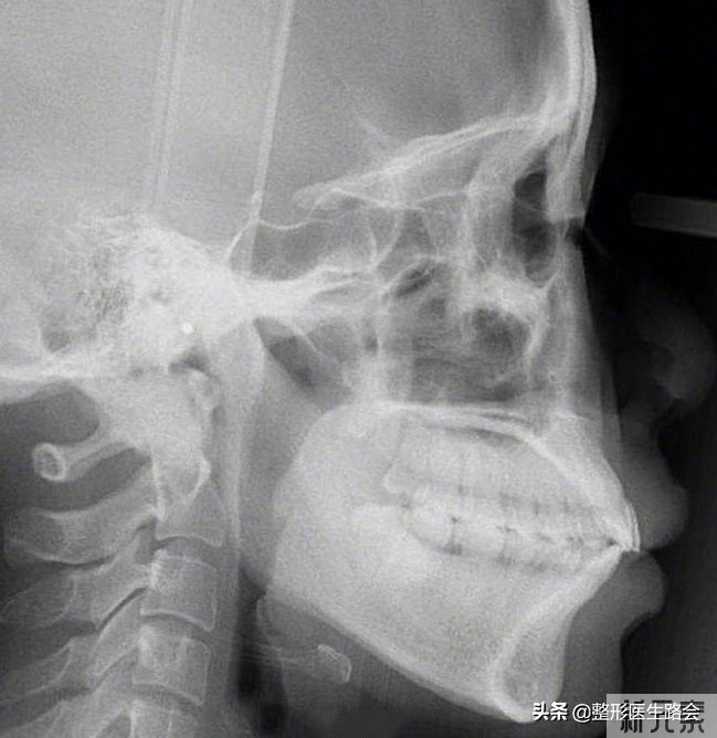 导致“嘴凸”的3个因素，看看你占几个?  图片-1