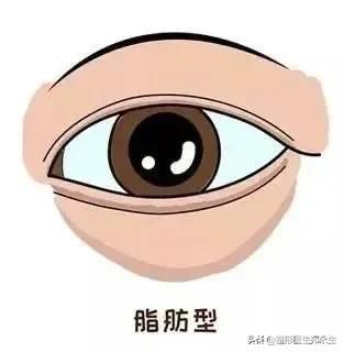 分型而治，眼袋的类型和治疗方式 图片-2