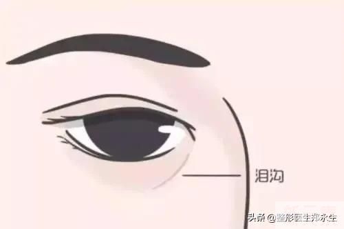 分型而治，眼袋的类型和治疗方式 图片-5