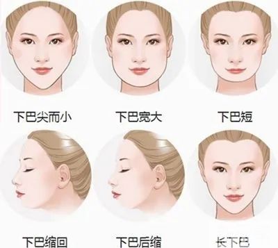 【医美小科普】改善面部轮廓从下巴开始 图片-2