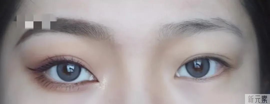 【医美小科普】做双眼皮之前需要注意什么 图片-4