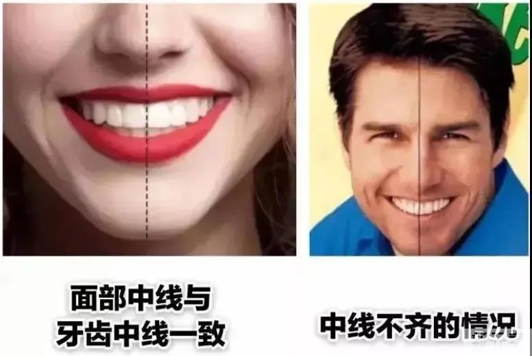 牙齿正畸有哪些选择?从来不敢开口笑的女生，都有一个心酸的秘密 图片-5