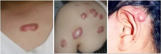 什么是疤痕体质?怎样才能预防疤痕产生? 图片-3